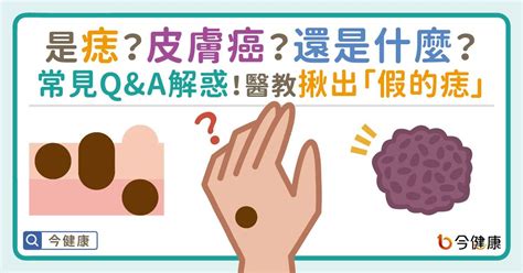 胸部長很多痣|是痣or皮膚癌？醫「1張圖秒對照」 長這2部位最危險